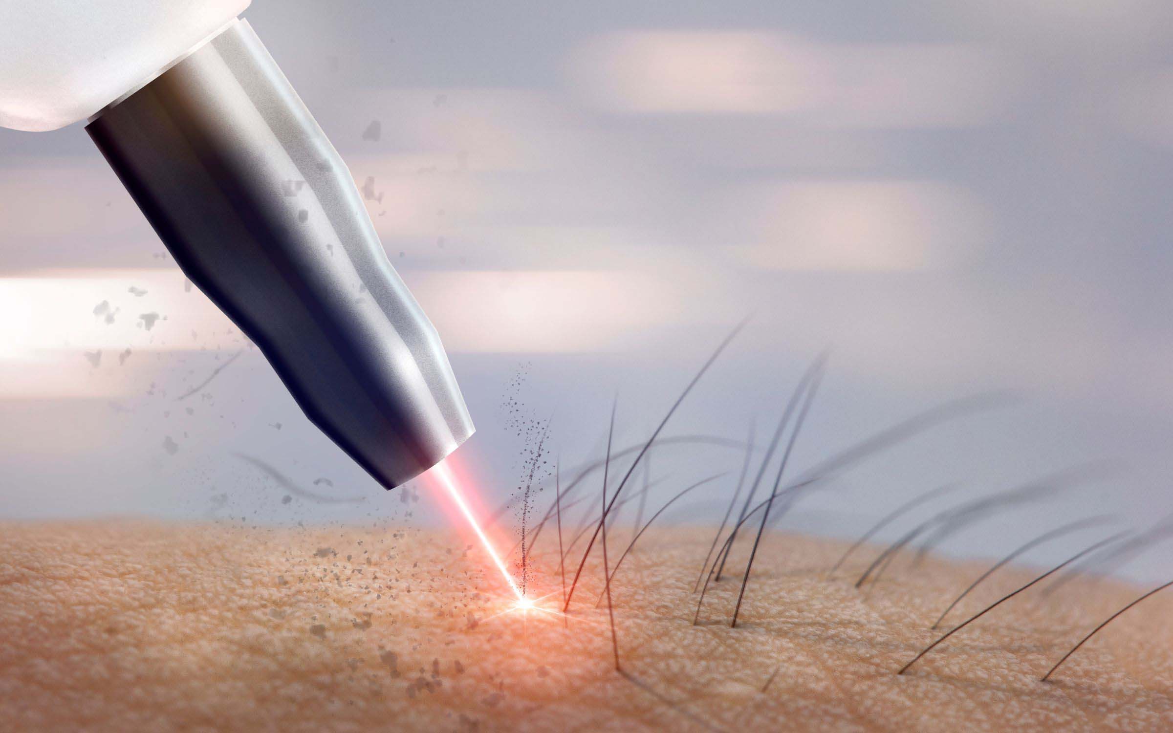 Laser Hair Removal in the Bikini