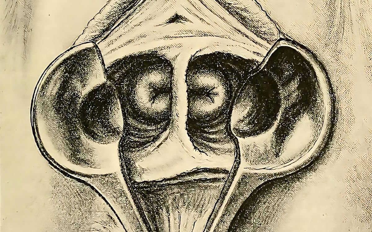 Understanding Uterus Didelphys and Embracing Self-Acceptance